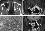 Wegener's granulomatosis.jpg