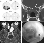 Wegener's granulomatosis2.jpg