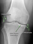 1.21_xrayrightkneeoafrontalco.jpg