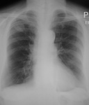 1.bronchial_ca2.jpg