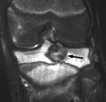 1.f1.mediumchondroblastomas.gif