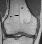 1.f15.mediumvnutrikostnoy_lipoma..gif