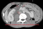 1.l.g.lacerated-horseshoe-kidney.jpg