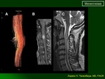 1.meningiomaslayd5.jpg