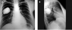 1.pleural_chondroma.jpeg