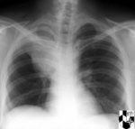 11.chest_carcinoma_1_pa.jpg