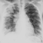 11.f36.mediumalveolyarnye_ehinokokkoz.gif