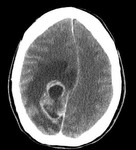 11.glioblastoma.jpg