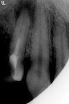 11.hronicheskiy_granulematoznyy_periodontit_14_zuba..jpg