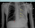 11.pnevmomediastinum.jpg