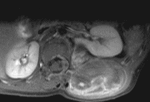 12.f29.mediumlipoblastoma.gif