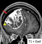 13.06252012qz_ri13.ghtkistoznyy_meningiomy.jpg