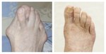 14_hallux-valgus-1_med_hr.jpeg