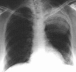 17.chest_carcinoma_lul_pa.jpg