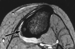 2.f12.mediumosteoida_osteomy.gif