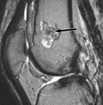 2.f14.mediumenchondromas.gif