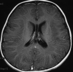 2.metahromaticheskaya_leykodistrofiya..gif