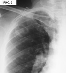 2.tuberkuloma.dsc02490.jpg