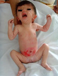 21.000004_web.apert_syndrome.jpg