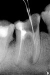 3.hronicheskiy_granulematoznyy_periodontit_46_zuba..jpg