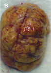 3.pleural_chondroma.jpeg