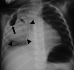 41.pulmonary_abscess_and_empyema.jpg