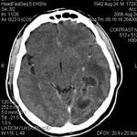 42.brain_aspergillosis_forming_an_abscess.jpg