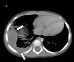 42.pulmonary_abscess_and_empyema.jpg