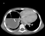 43.pulmonary_abscess_and_empyema.jpg