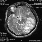 44.brain_aspergillosis_forming_an_abscess.jpg