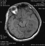 45.brain_aspergillosis_forming_an_abscess.jpg