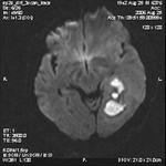 47.brain_aspergillosis_forming_an_abscess.jpg