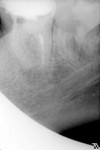 5.hronicheskiy_granulematoznyy_periodontit_37_zuba..jpg