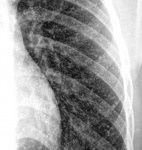 5.thorax-1ab.jpg