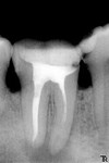 7.hronicheskiy_granulematoznyy_periodontit_47_zuba..jpg