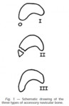 accessory_navicular_bone_variants.jpg