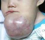 ameloblastoma2.jpg