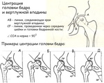 congenital_dislocation_of_the_hip5-5.jpg