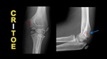 elbow_ossification_centers_critoe_-_radiology_video_tutorial19-18-51.jpg