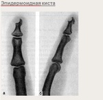 epidermoidnaya_kista.jpg