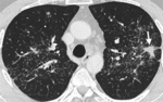 f10.mediumpulmonary_sarcoidosis.gif