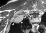 f12.mediumdiagnoz_fibromatoz..gif