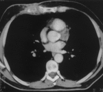 f12.mediumsternal_osteomielit.gif