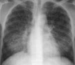 f13.mediummiliarnyy_tuberkulez.gif