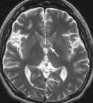 f16.mediumneyrosarkoidoz.gif