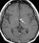 f17.mediumneyrosarkoidoz.gif