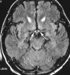 f19.mediumneyrosarkoidoz.gif