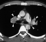 f2.mediumvnutrigrudnoy_limfadenopatii.gif