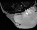 f22.medium._terminal_myelocystocele..gif