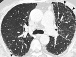 f27.mediumsubplevralno_sot-kak_kisty.gif